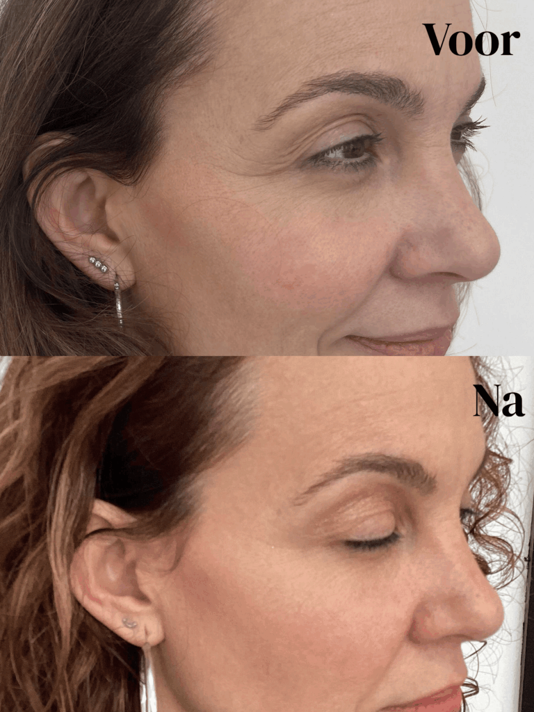 Voor en na foto 2 van botox kraaienpootje behandeling