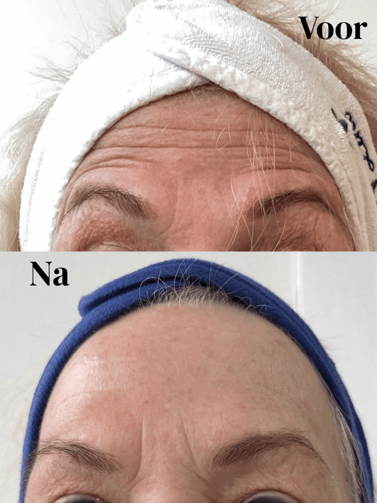 Voor en na foto van de botox voorhoofdbehandeling 1