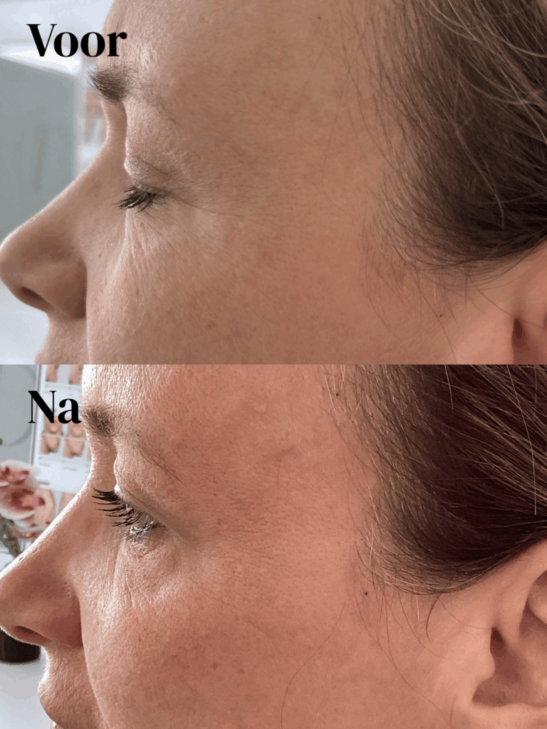 Voor en na foto 1 van botox kraaienpootje behandeling